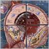 "Poster of Atherosclerosis Disease Progression" Poster of Atherosclerosis Disease Progression